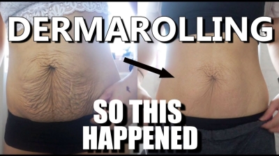 I Tried DERMAROLLING my Saggy Skin  & This Happened! (Astonishing Results)