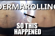 I Tried DERMAROLLING my Saggy Skin  & This Happened! (Astonishing Results)
