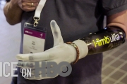 How Bionic Limbs Are Changing Lives