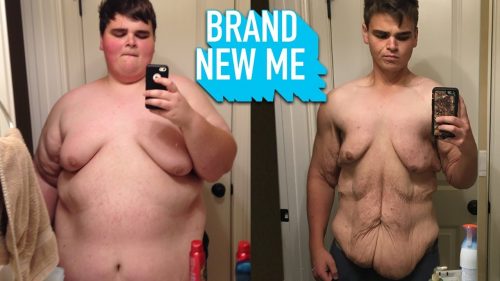 I Lost 230lbs And I’m Proud Of My Saggy Skin